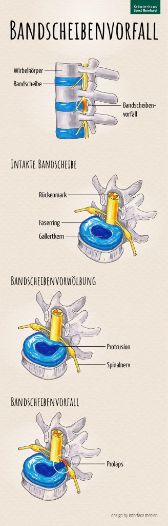 Infografik Bandscheibenvorfall