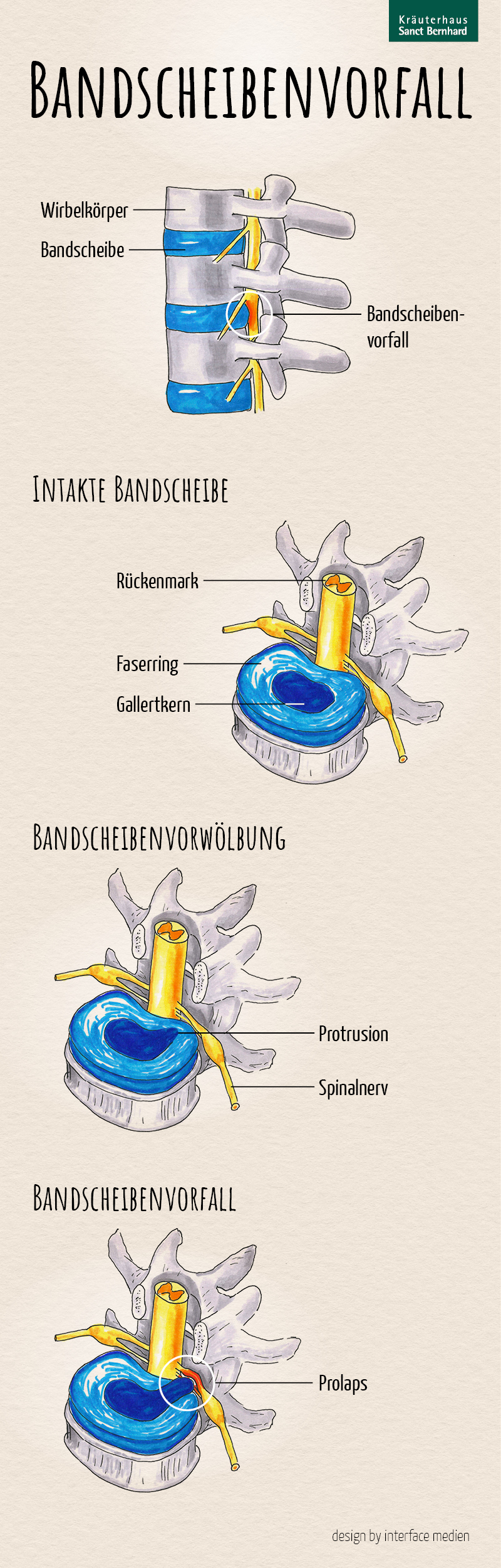 Diagnose Bandscheibenvorfall Was bedeutet das für Betroffene?