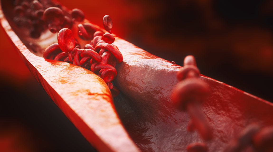 Cholesterin verstopft die Blutbahn